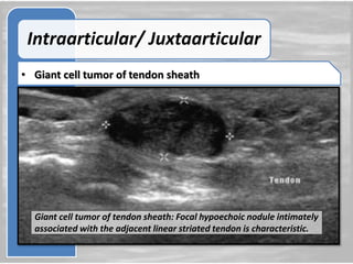 Role of ultrasound and color Doppler in evaluation of musculoskeletal soft tissue masses