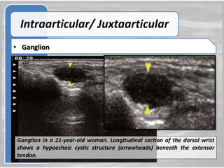 Role of ultrasound and color Doppler in evaluation of musculoskeletal soft tissue masses