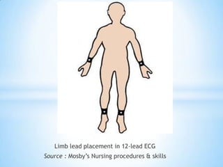 Limb lead placement in 12-lead ECG
Source : Mosby’s Nursing procedures & skills
 