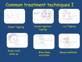 Common treatment techniques I  Bite Chew activities  Gauze methods 