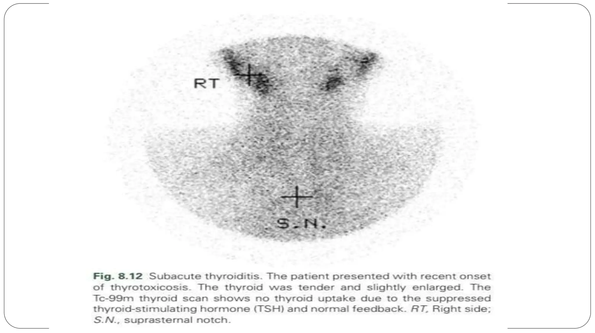 my presentation on grave disease differential diagnosis.pptx