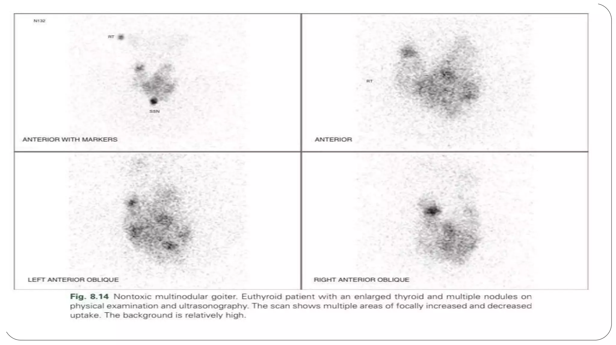 my presentation on grave disease differential diagnosis.pptx