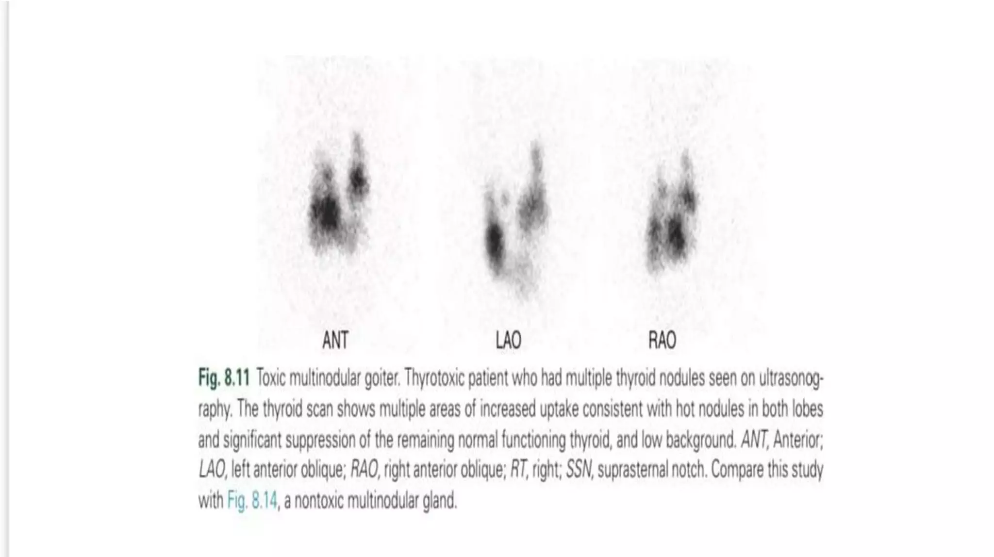 my presentation on grave disease differential diagnosis.pptx