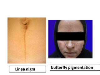 Linea nigra

butterfly pigmentation

 