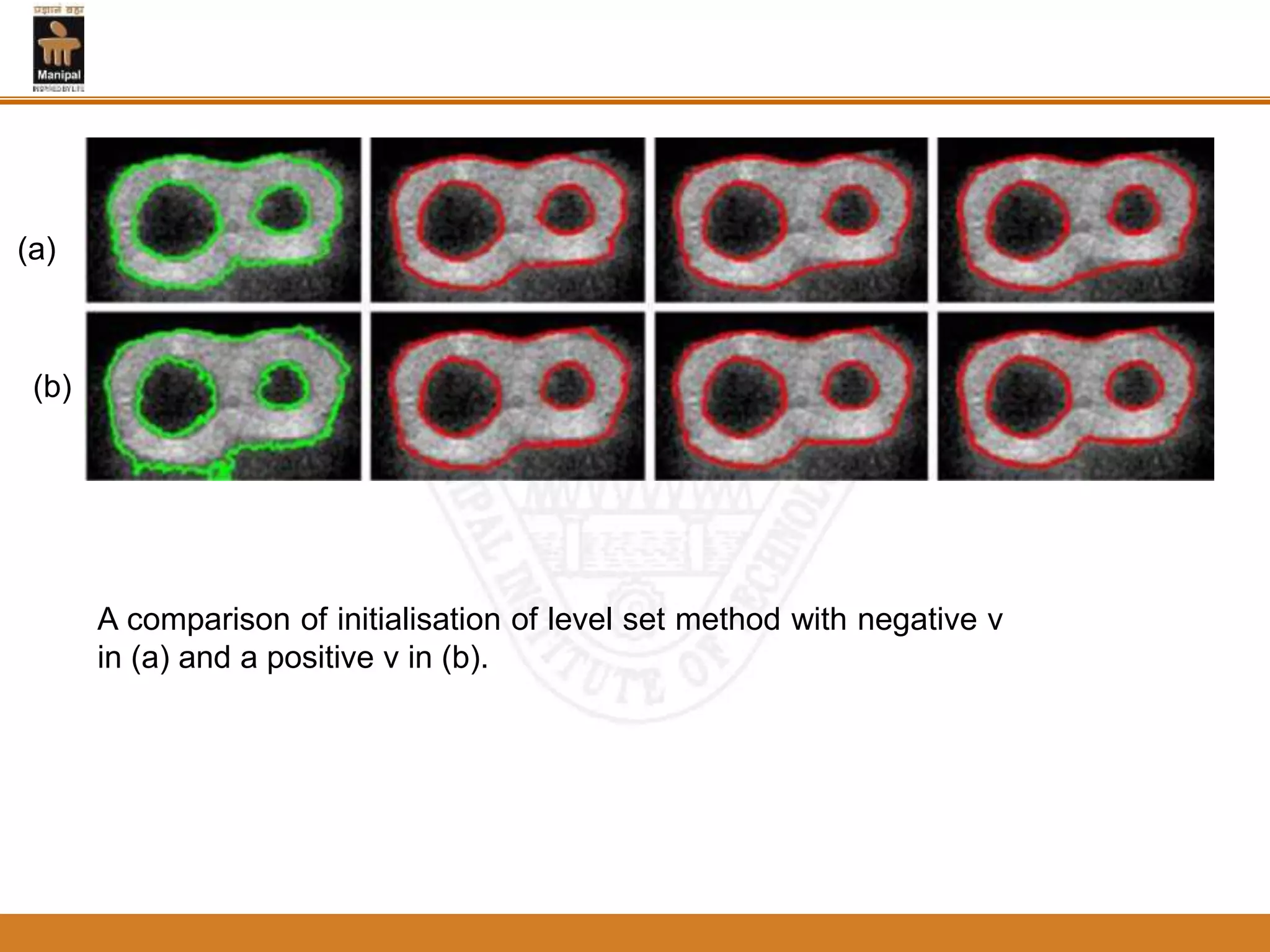 A comparison of initialisation of level set method with negative v
in (a) and a positive v in (b).
(a)
(b)
 