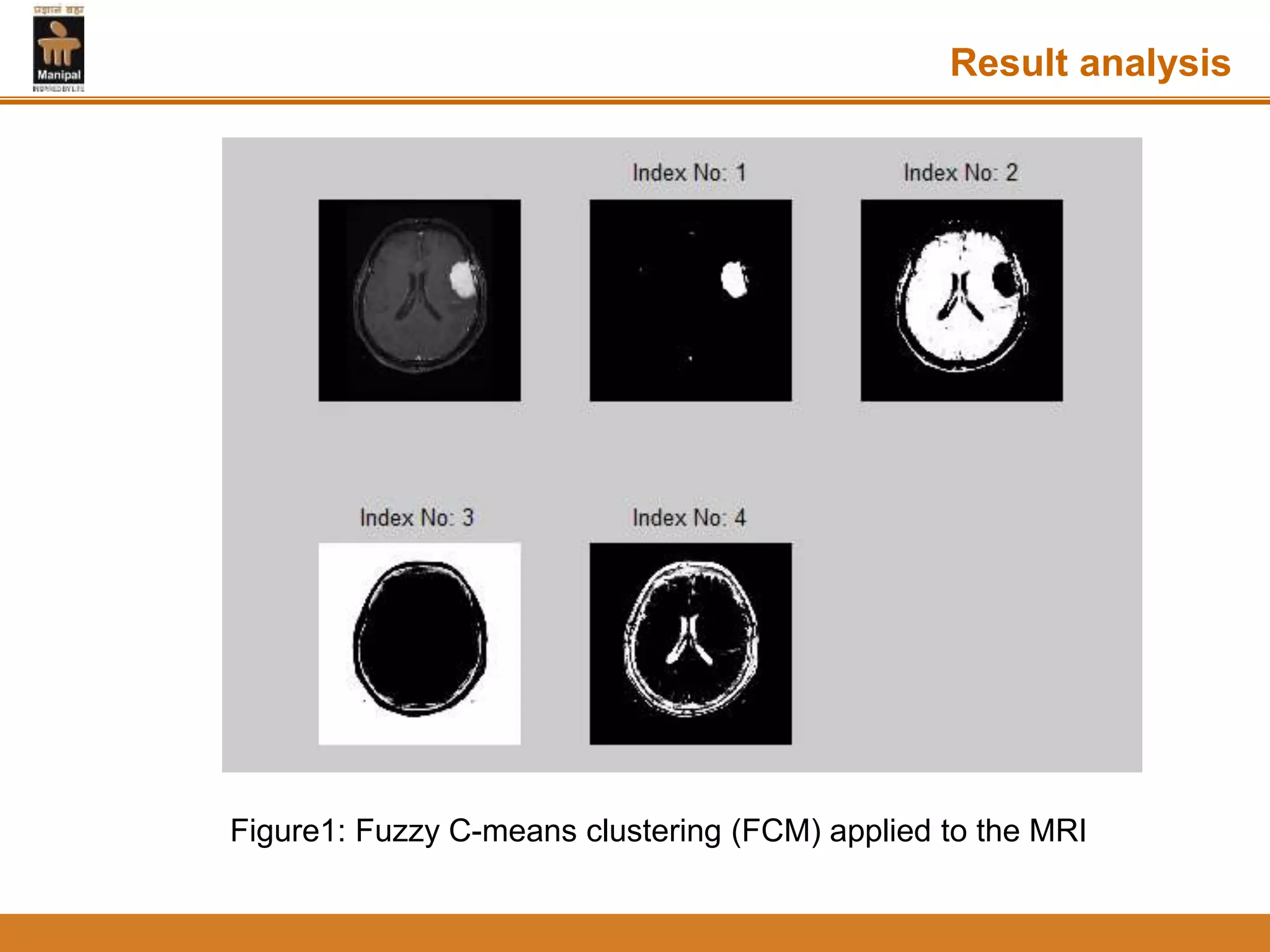 Result analysis
Figure1: Fuzzy C-means clustering (FCM) applied to the MRI
 