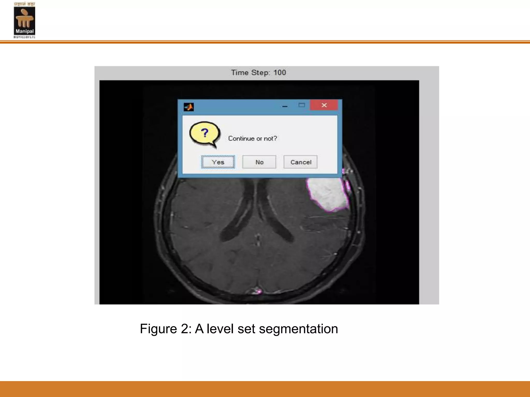 Figure 2: A level set segmentation
 