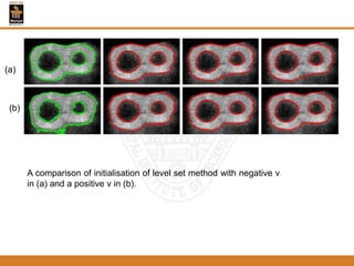 A comparison of initialisation of level set method with negative v
in (a) and a positive v in (b).
(a)
(b)
 
