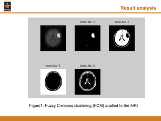 Result analysis
Figure1: Fuzzy C-means clustering (FCM) applied to the MRI
 
