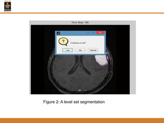 Figure 2: A level set segmentation
 