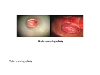 Video – myringoplasty
Underlay myringoplasty
 