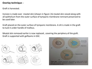 Overlay technique :-
Graft is harvested.
Incision is made over meatal skin (shown in figure ) & meatal skin raised along with
all epithelium from the outer surface of tympanic membrane remnant preserved to
be used later.
Graft placed on the outer surface of tympanic membrane. A slit is made in the graft
to tuck it under handle of malleus.
Meatal skin removed earlier is now replaced , covering the periphery of the graft.
Graft is supported with gelfoams in EAC.
 