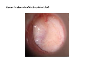 Postop Perichondrium/ Cartilage Island Graft
 