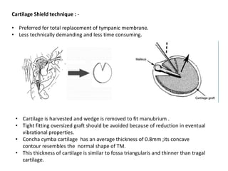 Cartilage Shield technique : -
• Preferred for total replacement of tympanic membrane.
• Less technically demanding and less time consuming.
• Cartilage is harvested and wedge is removed to fit manubrium .
• Tight fitting oversized graft should be avoided because of reduction in eventual
vibrational properties.
• Concha cymba cartilage has an average thickness of 0.8mm ;its concave
contour resembles the normal shape of TM.
• This thickness of cartilage is similar to fossa triangularis and thinner than tragal
cartilage.
 