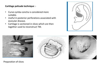 Cartilage palisade technique :-
• Curve cymba concha is considered more
suitable.
• Useful in posterior perforations associated with
ossicular disease.
• Cartilage is sectioned in slices which are then
together used to reconstruct TM.
Preparation of slices
 