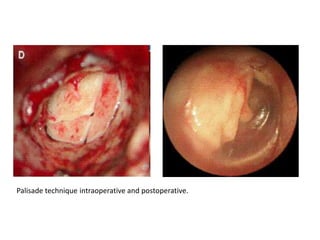 Palisade technique intraoperative and postoperative.
 