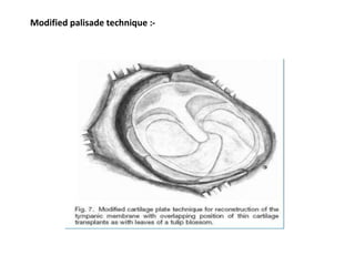 Modified palisade technique :-
 