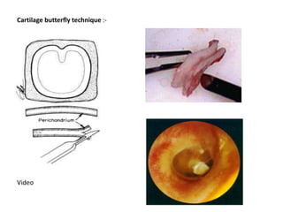 Cartilage butterfly technique :-
Video
 