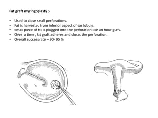 Fat graft myringoplasty :-
• Used to close small perforations.
• Fat is harvested from inferior aspect of ear lobule.
• Small piece of fat is plugged into the perforation like an hour glass.
• Over a time , fat graft adheres and closes the perforation.
• Overall success rate – 90- 95 %
 