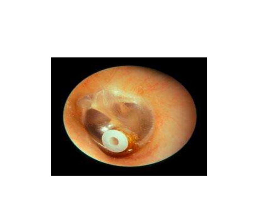 Myringotomy and grommet insertion