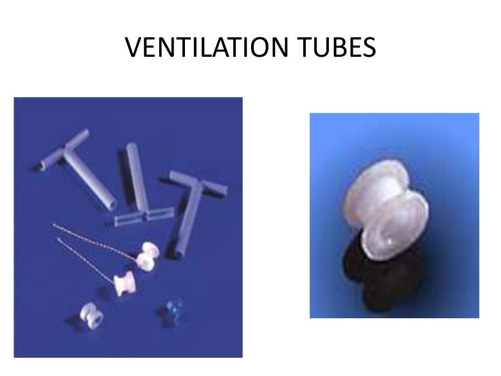 Myringotomy and grommet insertion