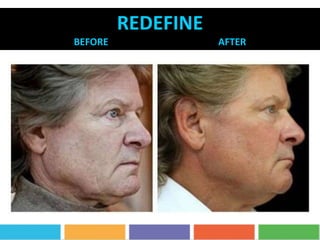 REDEFINE
BEFORE AFTER
 