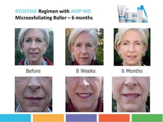 REDEFINE Regimen with AMP MD
Microexfoliating Roller – 6 months
 