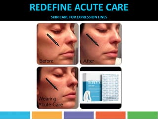 REDEFINE ACUTE CARE
SKIN CARE FOR EXPRESSION LINES
 