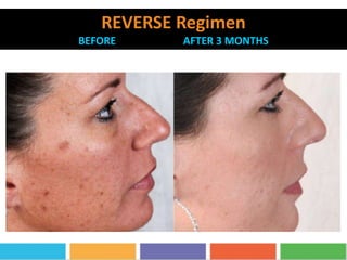 REVERSE Regimen
BEFORE AFTER 3 MONTHS
 
