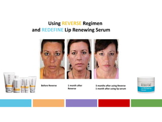 Using REVERSE Regimen
and REDEFINE Lip Renewing Serum
Before Reverse 1 month after
Reverse
3 months after using Reverse
1 month after using lip serum
 