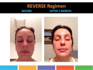 REVERSE Regimen
BEFORE AFTER 1 MONTH
 