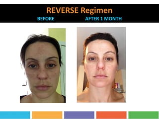 REVERSE Regimen
BEFORE AFTER 1 MONTH
 