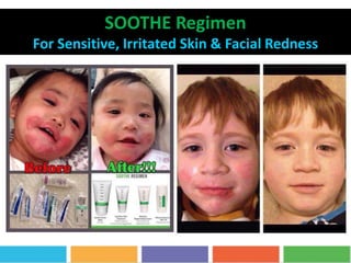 SOOTHE Regimen
For Sensitive, Irritated Skin & Facial Redness
 