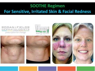 SOOTHE Regimen
For Sensitive, Irritated Skin & Facial Redness
 