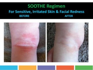 SOOTHE Regimen
For Sensitive, Irritated Skin & Facial Redness
BEFORE AFTER 5 MONTHS
 