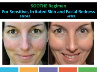 SOOTHE Regimen
For Sensitive, Irritated Skin and Facial Redness
BEFORE AFTER 5 MONTHS
 