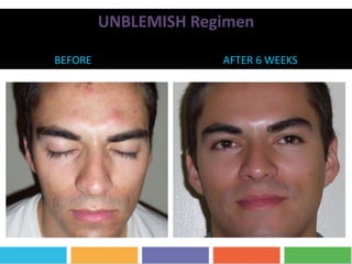 UNBLEMISH Regimen
BEFORE AFTER 6 WEEKS
 