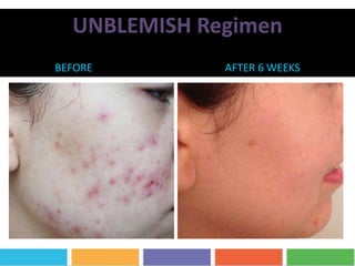 UNBLEMISH Regimen
BEFORE AFTER 6 WEEKS
 