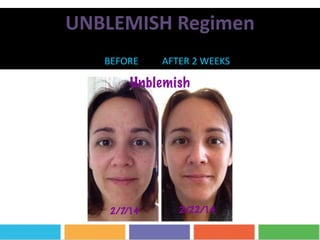 UNBLEMISH Regimen
BEFORE AFTER 2 WEEKS
 