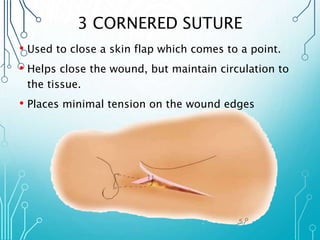 3 CORNERED SUTURE 
• Used to close a skin flap which comes to a point. 
• Helps close the wound, but maintain circulation to 
the tissue. 
• Places minimal tension on the wound edges 
 
