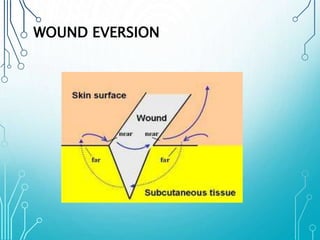 WOUND EVERSION 
 