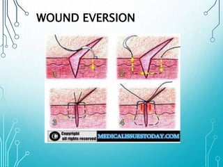 WOUND EVERSION 
 