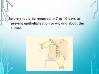 Suture should be removed in 7 to 10 days to 
prevent epithelialization or wicking about the 
suture 
 