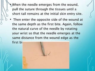 • When the needle emerges from the wound, 
pull the suture through the tissues until a 
short tail remains at the initial skin entry site. 
• Then enter the opposite side of the wound at 
the same depth as the first bite. Again, follow 
the natural curve of the needle by rotating 
your wrist so that the needle emerges at the 
same distance from the wound edge as the 
first bite and at right angles 
 