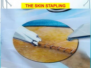 THE SKIN STAPLING 
 