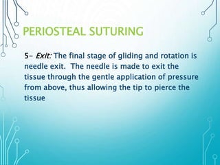 PERIOSTEAL SUTURING 
5- Exit: The final stage of gliding and rotation is 
needle exit. The needle is made to exit the 
tissue through the gentle application of pressure 
from above, thus allowing the tip to pierce the 
tissue 
 