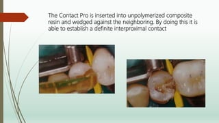 The Contact Pro is inserted into unpolymerized composite
resin and wedged against the neighboring. By doing this it is
able to establish a definite interproximal contact
 