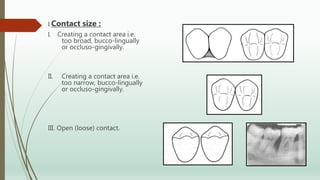 I Contact size :
I. Creating a contact area i.e.
too broad, bucco-lingually
or occluso-gingivally.
II. Creating a contact area i.e.
too narrow, bucco-lingually
or occluso-gingivally.
III. Open (loose) contact.
 