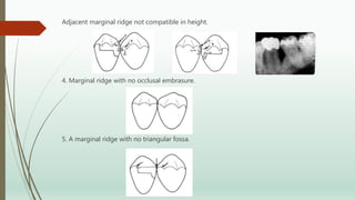 Adjacent marginal ridge not compatible in height.
4. Marginal ridge with no occlusal embrasure.
5. A marginal ridge with no triangular fossa.
 