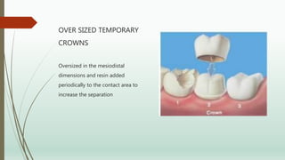 OVER SIZED TEMPORARY
CROWNS
Oversized in the mesiodistal
dimensions and resin added
periodically to the contact area to
increase the separation
 
